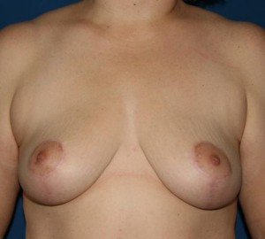 Breast Lift