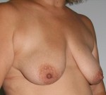 Breast Lift