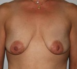 Breast Lift
