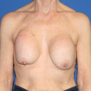 Breast Implant Revision