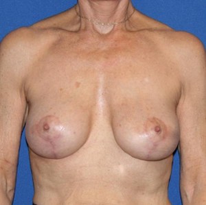 Breast Implant Revision