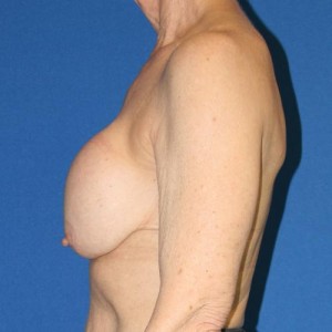 Breast Implant Revision
