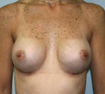 Breast Augmentation