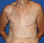 Breast Reconstruction after Cancer Surgery