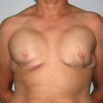 Breast Reconstruction after Cancer Surgery