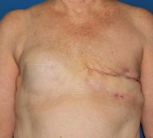 Breast Reconstruction after Cancer Surgery