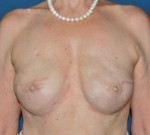 Breast Reconstruction after Cancer Surgery