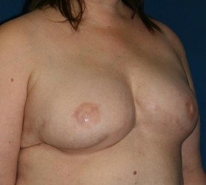 Breast Reconstruction after Cancer Surgery