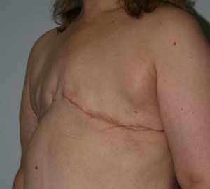 Breast Reconstruction after Cancer Surgery