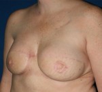 Breast Reconstruction after Cancer Surgery