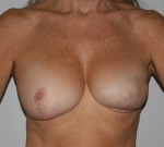 Breast Reconstruction after Cancer Surgery