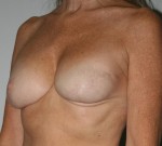 Breast Reconstruction after Cancer Surgery