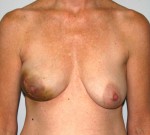 Breast Reconstruction after Cancer Surgery
