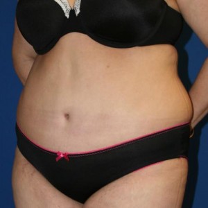 Tummy Tuck