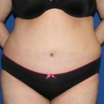 Tummy Tuck