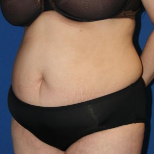 Tummy Tuck