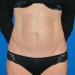 Tummy Tuck