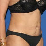 Tummy Tuck