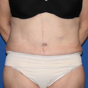 Tummy Tuck