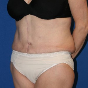 Tummy Tuck