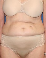 Tummy Tuck
