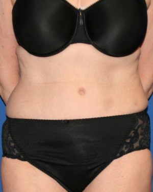 Tummy Tuck