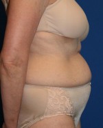 Tummy Tuck