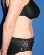 Tummy Tuck