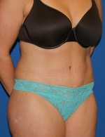 Tummy Tuck
