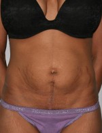 Tummy Tuck