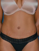 Tummy Tuck