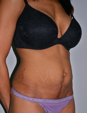 Tummy Tuck