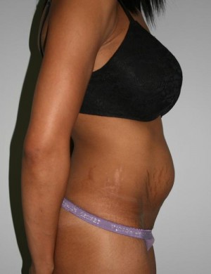 Tummy Tuck