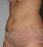 Tummy Tuck