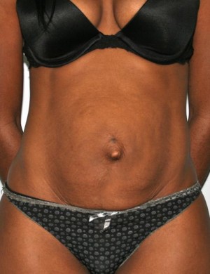 Tummy Tuck