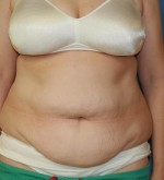Tummy Tuck