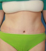 Tummy Tuck
