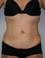 Tummy Tuck