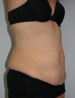 Tummy Tuck