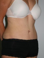 Tummy Tuck