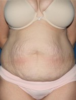 Tummy Tuck