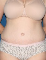 Tummy Tuck