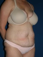 Tummy Tuck