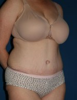 Tummy Tuck