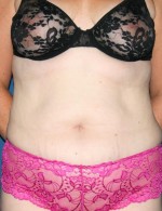 Tummy Tuck