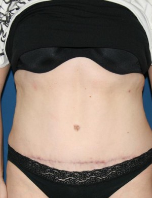 Tummy Tuck