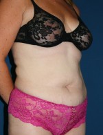 Tummy Tuck