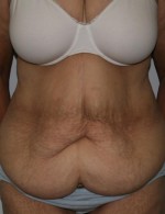 Tummy Tuck