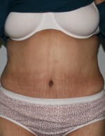 Tummy Tuck