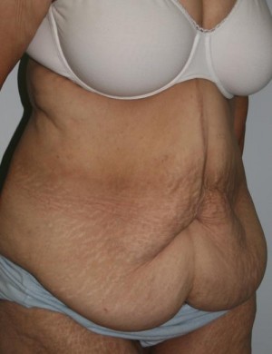 Tummy Tuck